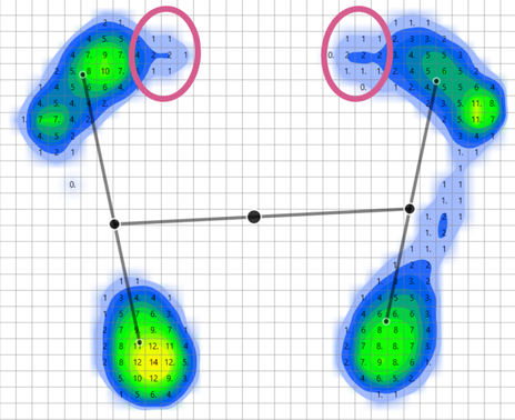 einlagen bei hallux valgus (1)